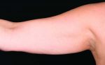 CoolSculpting