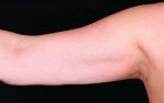 CoolSculpting