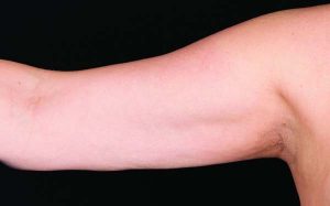 CoolSculpting Case 728 After Photo CoolSculpting