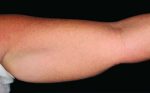 CoolSculpting