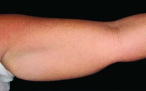 CoolSculpting Case 732 Before Photo CoolSculpting