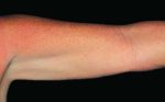 CoolSculpting