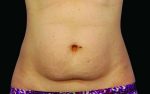 CoolSculpting