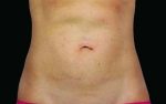 CoolSculpting