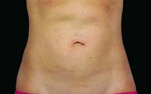 CoolSculpting Case 736 After Photo CoolSculpting