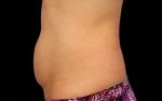 CoolSculpting