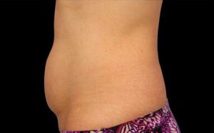 CoolSculpting Case 736 Before Photo CoolSculpting