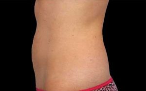 CoolSculpting Case 736 After Photo CoolSculpting