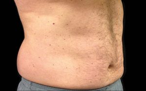 CoolSculpting Case 742 Before Photo CoolSculpting