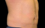 CoolSculpting