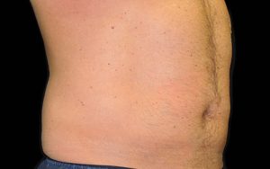 CoolSculpting Case 742 After Photo CoolSculpting