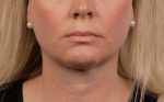 CoolSculpting