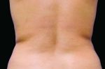 CoolSculpting
