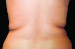 CoolSculpting
