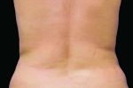 CoolSculpting