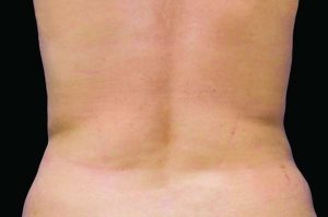 CoolSculpting