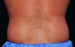 CoolSculpting