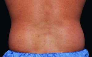 CoolSculpting Case 760 Before Photo CoolSculpting