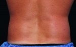 CoolSculpting