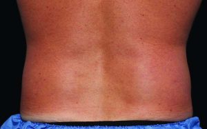 CoolSculpting Case 760 After Photo CoolSculpting