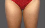 CoolSculpting