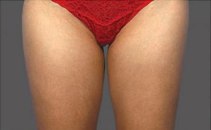 CoolSculpting Case 764 Before Photo CoolSculpting