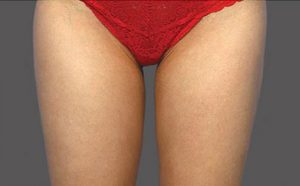 CoolSculpting Case 764 After Photo CoolSculpting