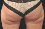 CoolSculpting