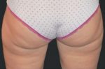 CoolSculpting