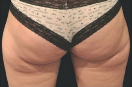 CoolSculpting