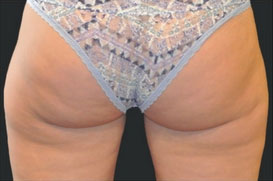 CoolSculpting